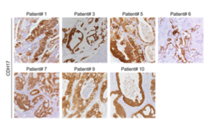 靶向鈣黏蛋白17(Cadherin-17/CDH17)的CAR-T細胞系統性遞送策略:安全有效治療結直腸癌肝轉移的新突破 靶向鈣黏蛋白17(Cadherin-17/CDH17)的CAR-T細胞系統性遞送策略:安全有效治療結直腸癌肝轉移的新突破
