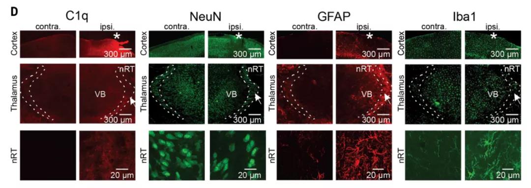 顱腦創傷后的繼發性腦損傷是怎么發生的?Science:補體介導炎癥及神經損傷!