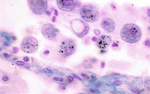 Science Immunology:巨噬細胞發(fā)育缺陷導致肺部疾病
