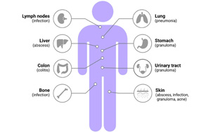 mNGS在診斷血流感染方面優于常規微生物檢測