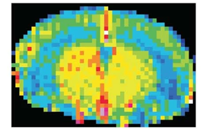 Nature Neuroscience:一種免疫蛋白可能誘發(fā)與高血壓無關(guān)的癡呆